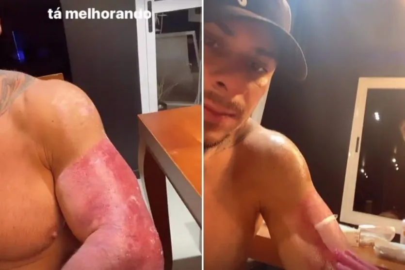 Leo Stronda mostra queimaduras após acidente doméstico