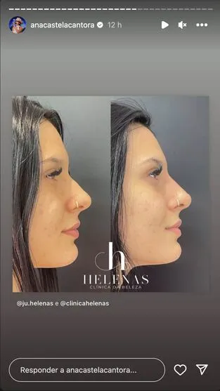 Ana Castela faz procedimento no nariz e mostra resultado; confira