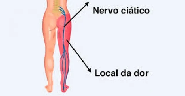  O nervo ciático é o maior nervo do corpo humano, que é formado pela união dos nervos menores que saem do final da coluna vertebral. 