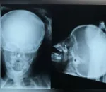 Médicos encontram parafuso em nariz de criança de 2 anos