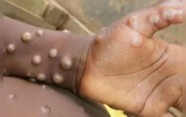 Brasil tem dois casos suspeitos de varíola dos macacos
