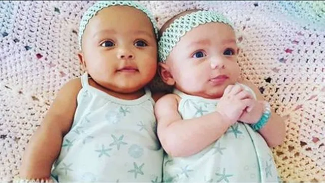 Menininhas gêmeas negra e branca causam surpresa em caso raro