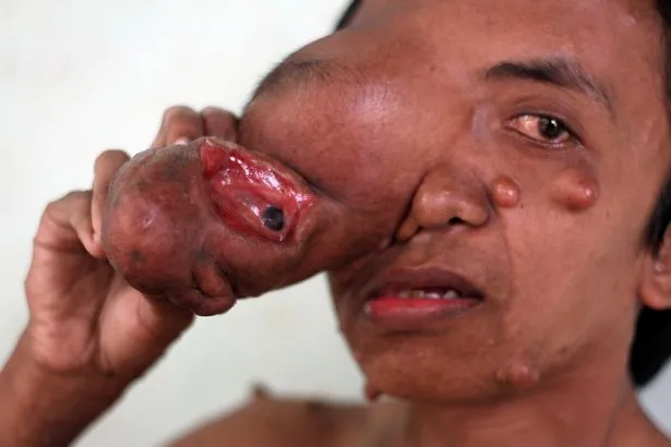 Homem que teve rosto tomado por tumor pede ajuda na internet; veja vídeo