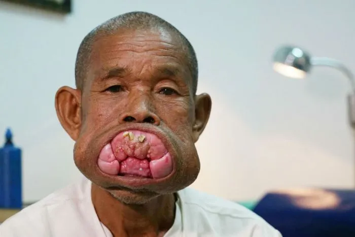 Homem que convivia com tumor na boca há 30 anos finalmente é operado; veja imagens