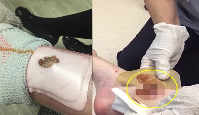 Estudante é picada por aranha e ferimento impressiona; veja vídeo