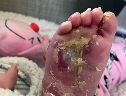Foto de bebê com doença rara é vetada pelo Facebook