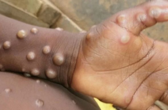 Brasil tem dois casos suspeitos de varíola dos macacos