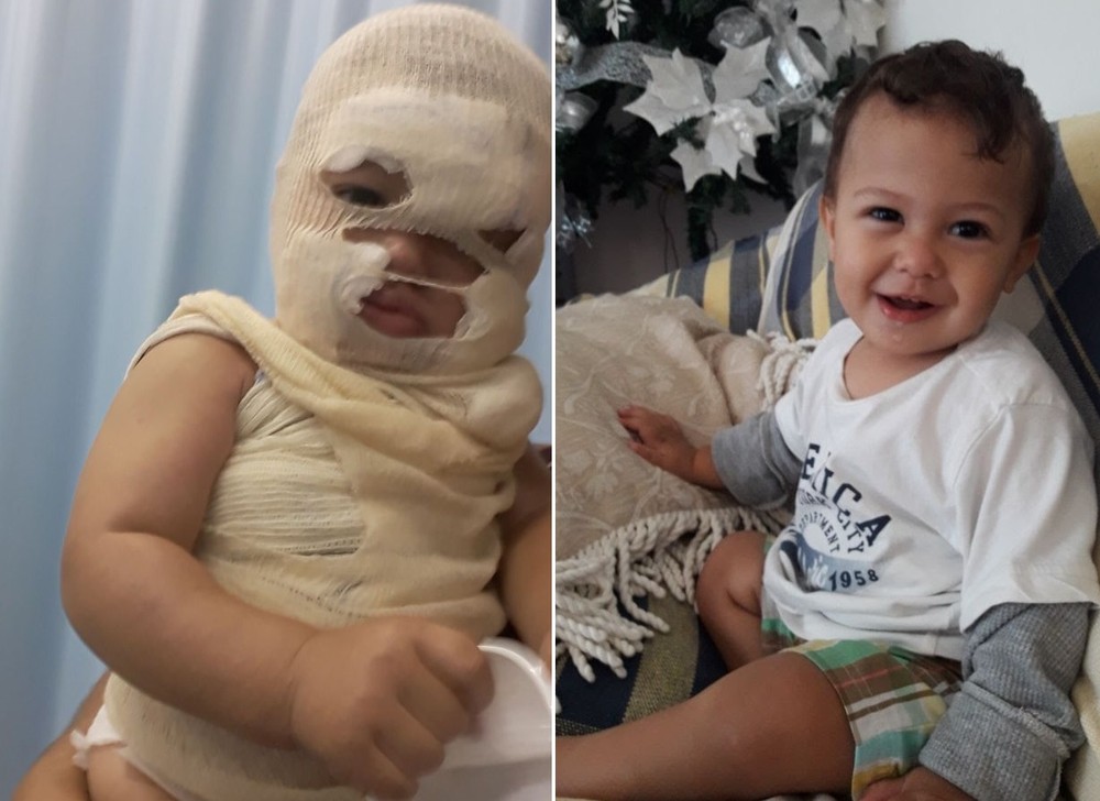 Menino Lorenzo se acidentou durante as férias da família em Itanhaém, SP (Foto: Arquivo Pessoal)