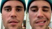 Justin Bieber, de 28 anos, assustou seus seguidores e fãs ao mostrar que metade do seu rosto está paralisado