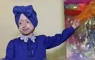 Com doença rara, garota de 10 anos morre 'de velhice'