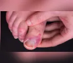 Pessoas desenvolvem lesões nos dedos após contraírem covid