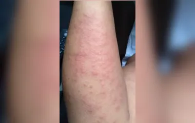 Surto de lesões na pele é investigado pela Saúde de Recife