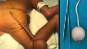 Raro: bebê brasileiro nasce com cauda e bola na extremidade