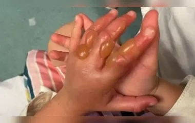 Criança toca em planta venenosa e sofre queimaduras de 3º grau