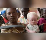 Albinos enfrentam discriminação e ataques no sul da África