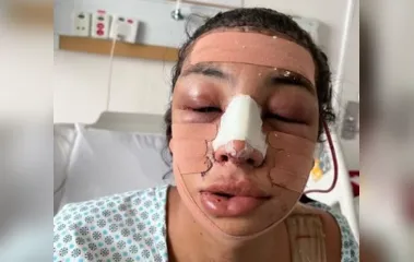 Linn da Quebrada faz cirurgia no rosto e mostra resultado; Veja