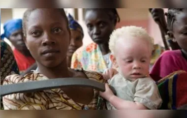 Albinos enfrentam discriminação e ataques no sul da África