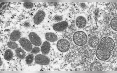 País está preparado para enfrentar a varíola, diz ministério; entenda