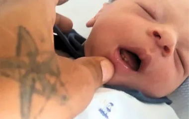 Bebê com condição rara nasce com dentes e surpreende equipe de saúde