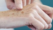 Medicina nuclear possibilita chances de cura para o câncer de pele